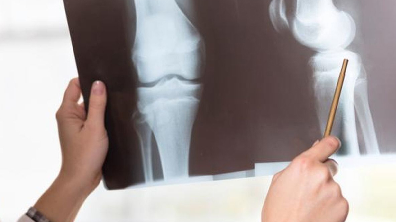 Penyakit Osteoporosis, Kenali Risiko dan Cara Mencegahnya – PAFI Banggae